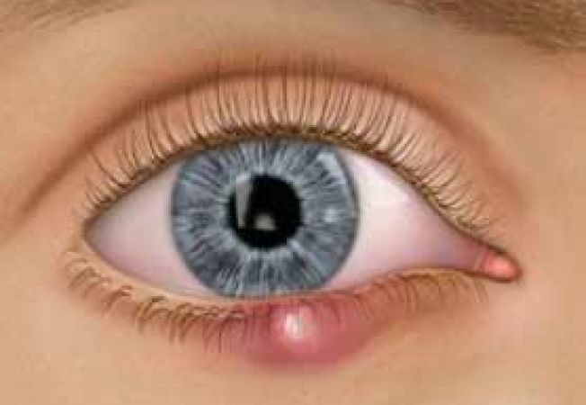 Не болезнь, а проклятие: как быстро вылечить ячмень на глазу | DOCTORPITER
