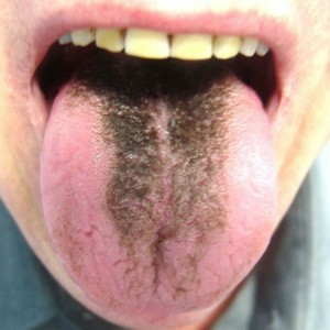 black-tongue