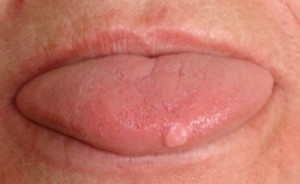 lesion-tongue