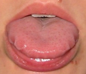scalloped-tongue