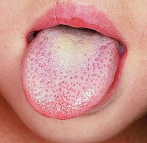white-tongue