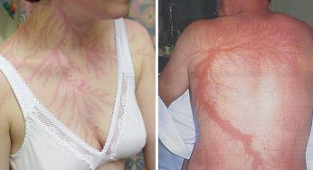 19 человек, которые выжили после попадания молнии. Они показывают, что случилось с их кожей